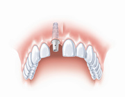 Does Getting Dental Implants Hurt?