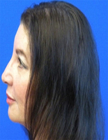 Female hair growth Laser treatment In California USA
